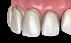 Porcelain Veneers West Brookfield, MA