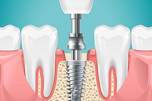 a closeup of the parts of a dental implant