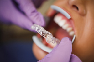 Dentist with purple gloves placing clear aligner on patient's teeth