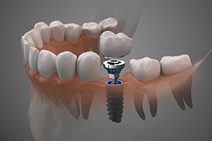 dental implant inserted into jawbone