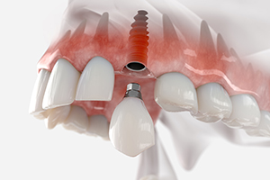 dental implant inserted into jawbone